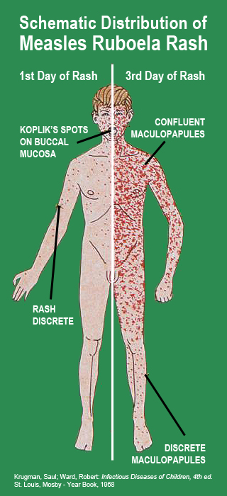 Diagram showing measles progression.